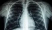 Beyaz akciğer sendromu nedir, belirtileri nelerdir? Vakalar patlıyor